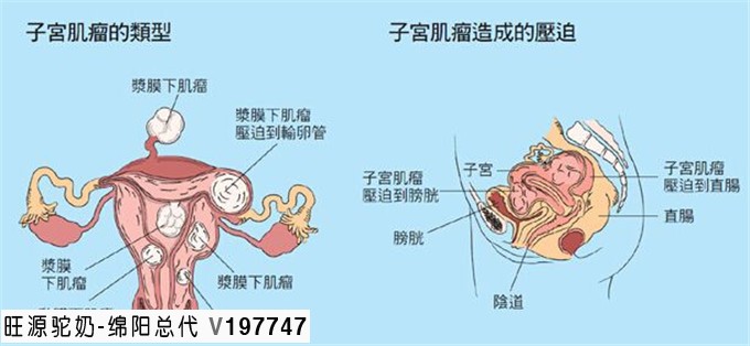 得了子宫肌瘤,为什么先治肝?