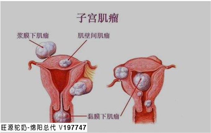 旺源骆驼奶绵阳总代理为您提供：得了子宫肌瘤，为什么先治肝？